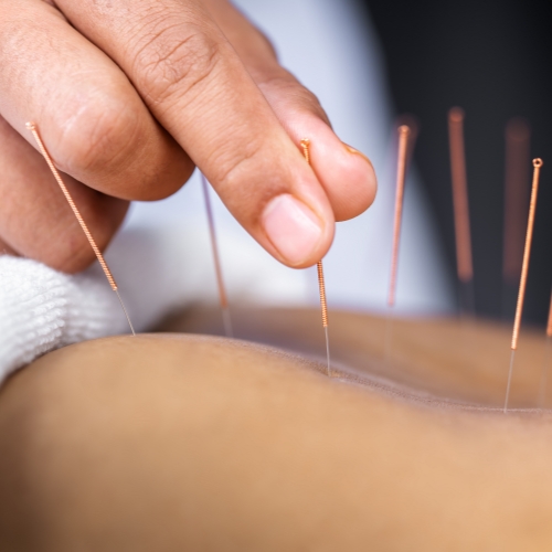 acupuncture-Ace-Physique-Calgary-AB