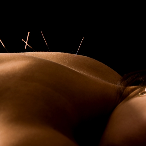 acupuncture-ace-physique-calgary-ab
