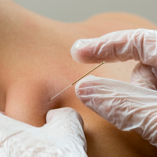 dry-needling-ace-physique-calgary-ab