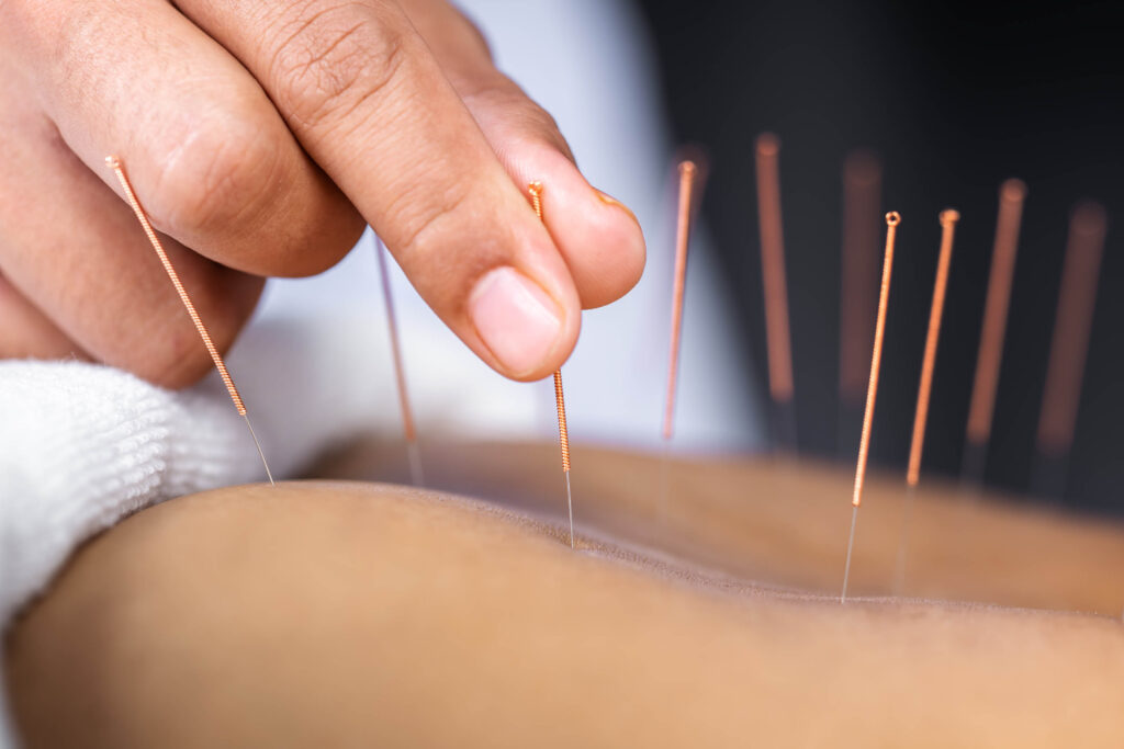 close up of specialist inserting acupuncture needle into patient's muscle to improve circulation