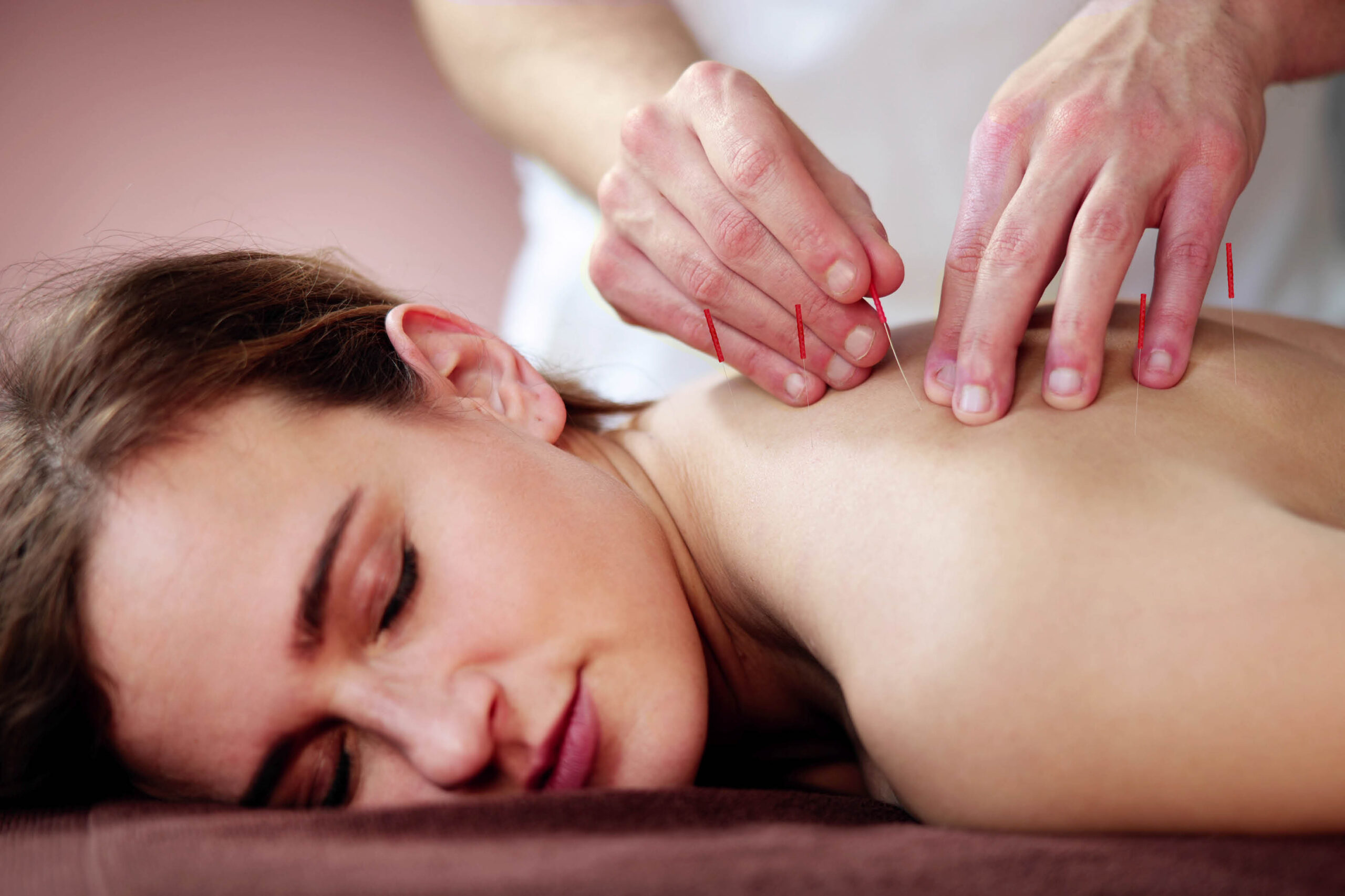 Specialist performing dry needling procedure on patient's shoulder to reduce muscle tension