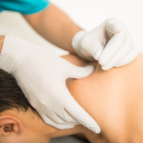 Physical therapist inserting needle into neck trigger point to relieve tension